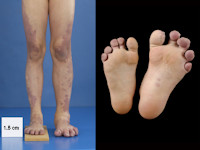 Klippel Trenaunay syndroom