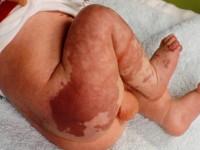 Klippel Trenaunay syndroom