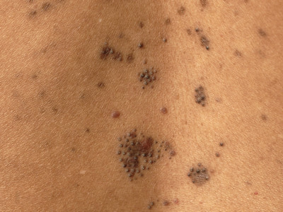 Lichen planopilaris type Graham-Little