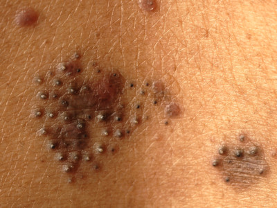 Lichen planopilaris type Graham-Little