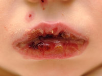 Mycoplasma pneumoniae-induced rash and mucositis