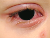 Mycoplasma pneumoniae-induced rash and mucositis