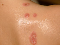 Mycoplasma pneumoniae-induced rash and mucositis