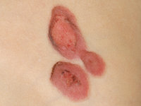 Mycoplasma pneumoniae-induced rash and mucositis