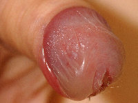 Mycoplasma pneumoniae-induced rash and mucositis