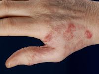 Granuloma trichophyticum (Majocchi granuloma)