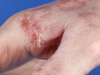 Granuloma trichophyticum (Majocchi granuloma)