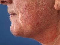 Granuloma trichophyticum (Majocchi granuloma)