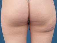 Morel-Lavalleé laesie