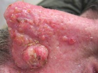 Keratoacanthoom bij het Muir-Torre syndroom