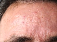 Sebaceous adenomas bij het Muir-Torre syndroom