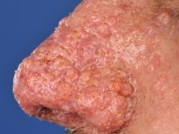 Sebaceous adenomas bij het Muir-Torre syndroom