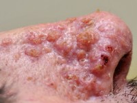 Sebaceous adenomas bij het Muir-Torre syndroom