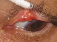 Sebaceous carcinoma bij het Muir-Torre syndroom