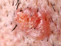 Sebaceous epithelioma bij het Muir-Torre syndroom