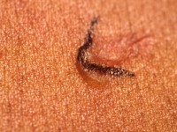 Nikolsky fenomeen 2, stevige blaar onder streepje door drukken