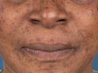 Postinflammatoire hyperpigmentatie bij acne