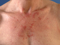 Chronische polymorfe lichteruptie