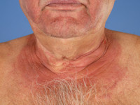 Chronische polymorfe lichteruptie