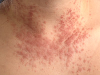 Chronische polymorfe lichteruptie