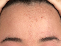 Chronische polymorfe lichteruptie