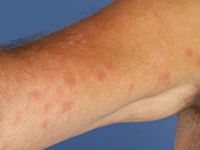 Chronische polymorfe lichteruptie