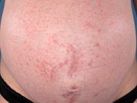 Impetigo bullosa