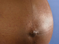 Impetigo bullosa