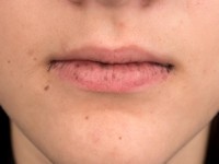 Peutz-Jeghers syndroom