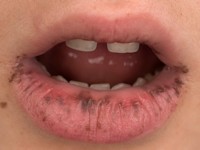 Peutz-Jeghers syndroom