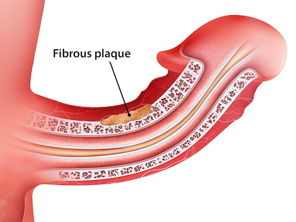 Peyronie's disease