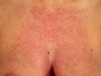 Reticulaire erythemateuze mucinosis (REM)