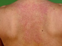 Reticulaire erythemateuze mucinosis (REM)