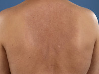 Reticulaire erythemateuze mucinosis (REM)