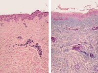 Reticulaire erythemateuze mucinosis (REM)