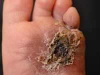 RICH (rapidly involuting congenital hemangioma)