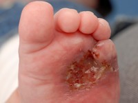 RICH (rapidly involuting congenital hemangioma)