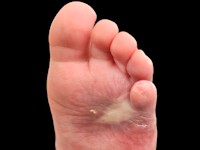 RICH (rapidly involuting congenital hemangioma)