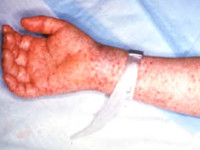 Rickettsia rickettsii