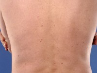 Rickettsia africa infectie