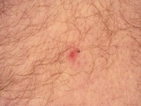 Rickettsia africa infectie