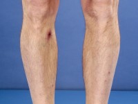 Rickettsia africa infectie