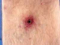 Rickettsia africa infectie