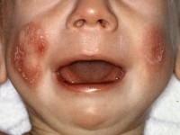 Rothmund-Thomson syndroom