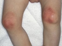 Rothmund-Thomson syndroom