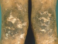 Rothmund-Thomson syndroom