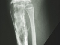 Rothmund-Thomson syndroom