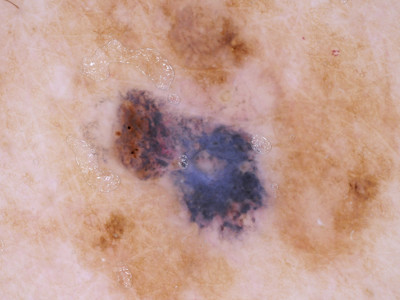 SAMPUS: Superficial atypical melanocytic proliferation of uncertain significance