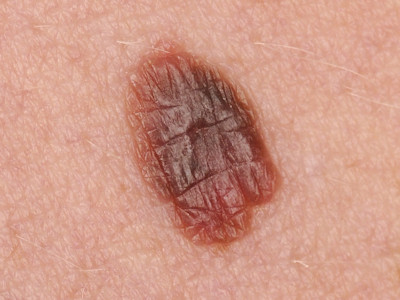 SAMPUS: Superficial atypical melanocytic proliferation of uncertain significance