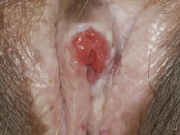 Plaveiselcelcarcinoom uitgaande van DVIN bij lichen sclerosus